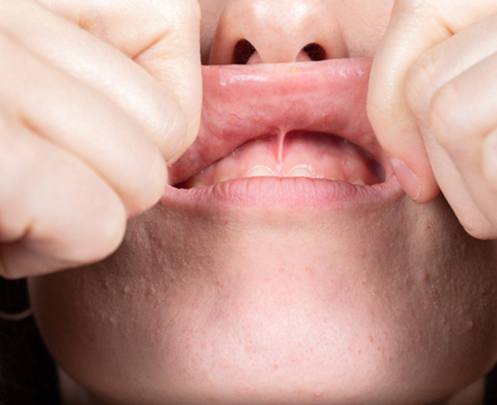 Patient in Pleasanton showing lip and tongue-ties